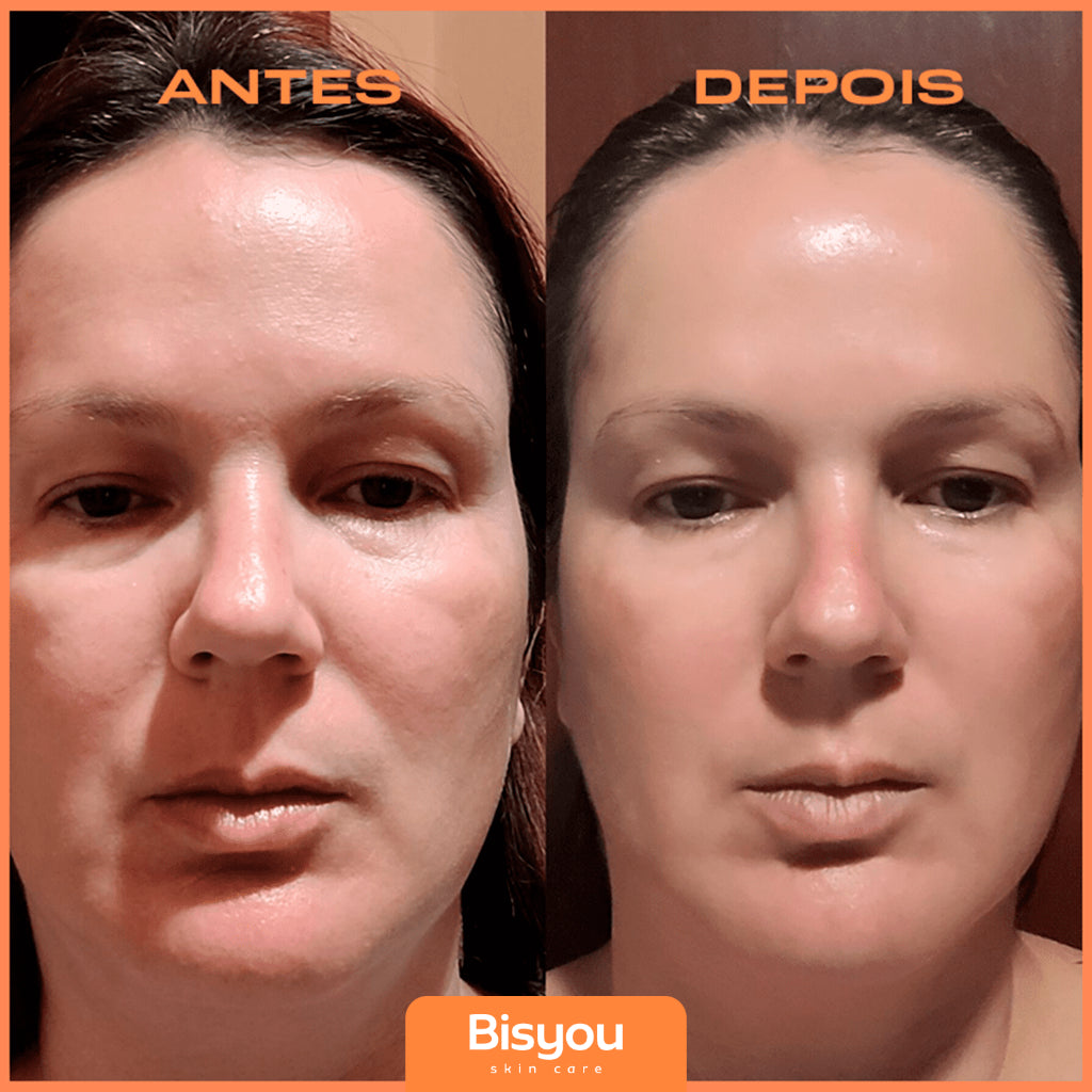 Preenchedor Facial e Labial Bisyou